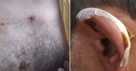 ഒരു ശരീരത്തില്‍ ഇരുപതോളം പെല്ലറ്റുകള്‍; അറസ്റ്റ് ഭയന്ന് ആശുപത്രിയില്‍ പോകാനാകുന്നില്ല, കശ്മീരില്‍ ശരീരത്തില്‍ നിന്ന് പെല്ലറ്റ് നീക്കുന്നത് ചവണ ഉപയോഗിച്ച്
