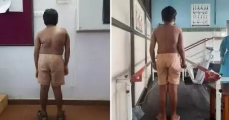 ജിത്തുവിന് ഇനി നിവര്‍ന്നു നില്‍ക്കാം; താങ്ങായത് സര്‍ക്കാര്‍ മെഡിക്കല്‍ കോളജിലെ ശസ്ത്രക്രിയ