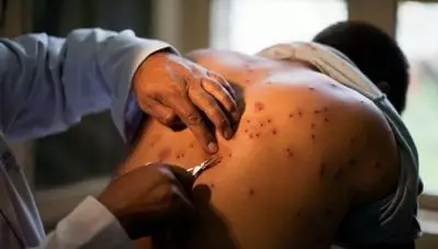 ശരീരത്തില്‍ 30 പെല്ലറ്റുകള്‍; നഷ്ടപരിഹാരം ആവശ്യപ്പെട്ട് വിദ്യാര്‍ത്ഥി സമരത്തിനിടെ പൊലീസ് അതിക്രമം നേരിട്ട മാധ്യമപ്രവര്‍ത്തകന്‍
