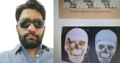 കാളയുടെ ആക്രമണത്തില്‍ മുഖം തകര്‍ന്നു; ഒരു വര്‍ഷം നീണ്ട ശസ്ത്രക്രിയകളിലൂടെ പുതിയ മുഖം