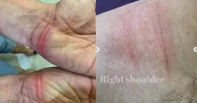ഷൂട്ടിംഗിനിടയില്‍ ചതഞ്ഞ പാടുകള്‍; രമേഷ് പിഷാരടി പങ്കുവെച്ച് ചിത്രങ്ങള്‍ ശ്രദ്ധ നേടുന്നു