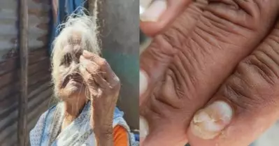 മുടിയ്ക്ക് പിന്നാലെ നഖങ്ങളും കൊഴിയുന്നു; ആശങ്കയിലായി മഹാരാഷ്ട്രയിലെ ഷെഗാവോണ്‍ ഗ്രാമവാസികള്‍
